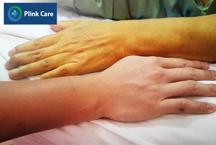 Vàng da là biểu hiện men gan tăng cao
