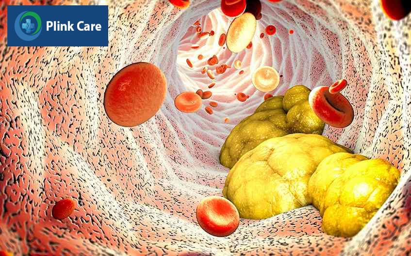 xét nghiệm mỡ máu gồm những chỉ số nào