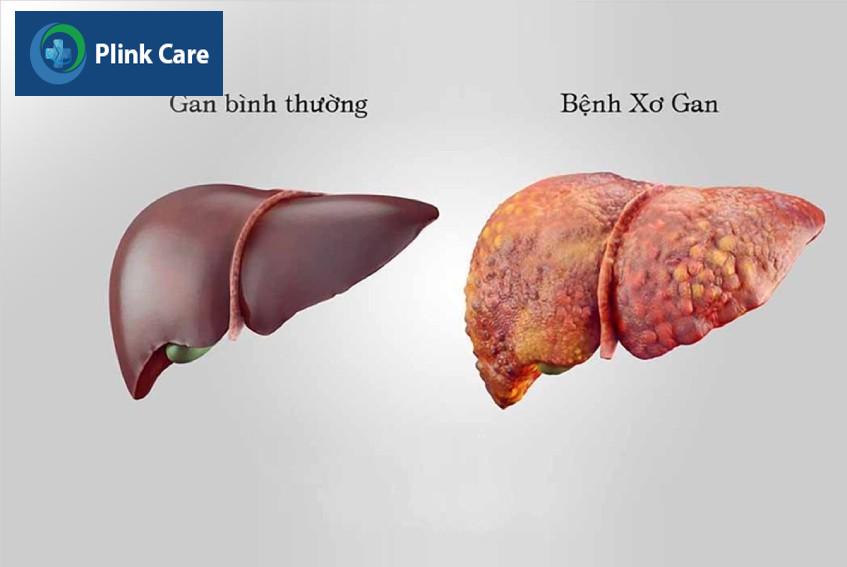 xơ gan biến chứng gan nhiễm mỡ