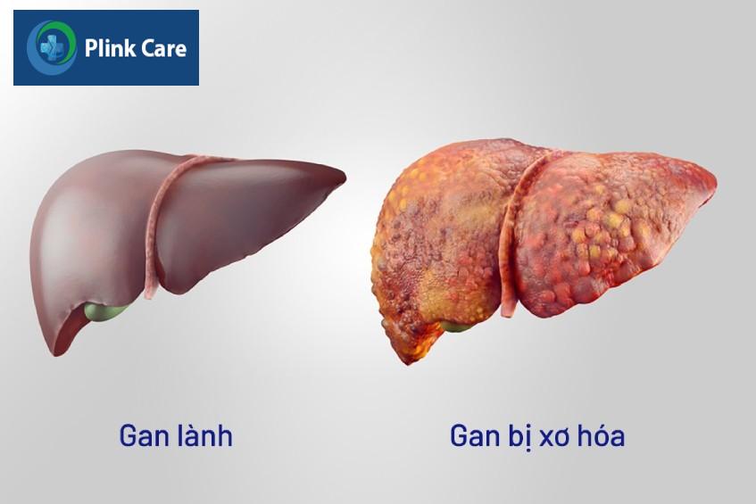 Xơ gan là yếu tố nguy cơ mắc ung thư gan