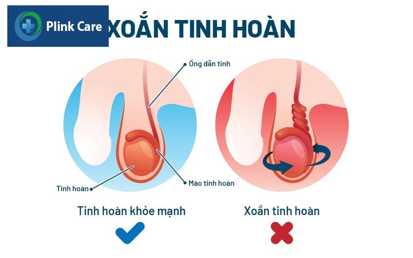 xoắn tinh hoàn