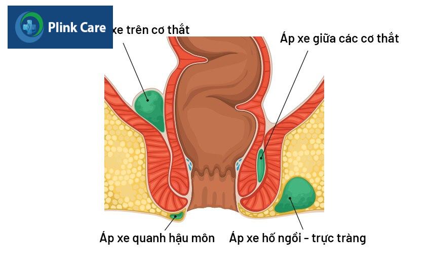 áp xe hậu môn là bệnh gì