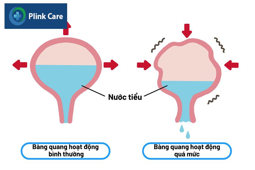 bàng quang hoạt động quá mức