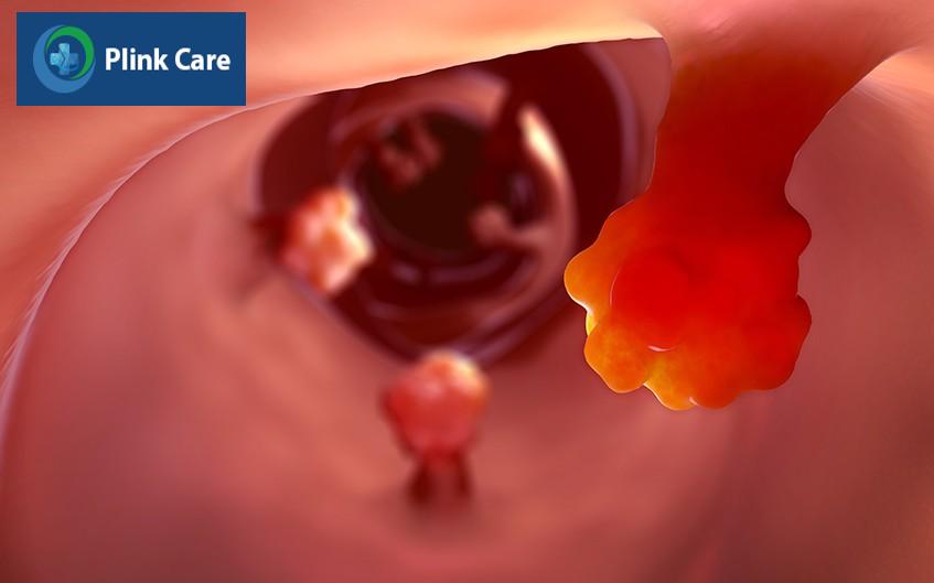 bị bệnh polyp hậu môn