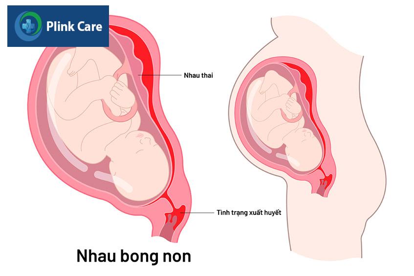 biến chứng chảy máu âm đạo