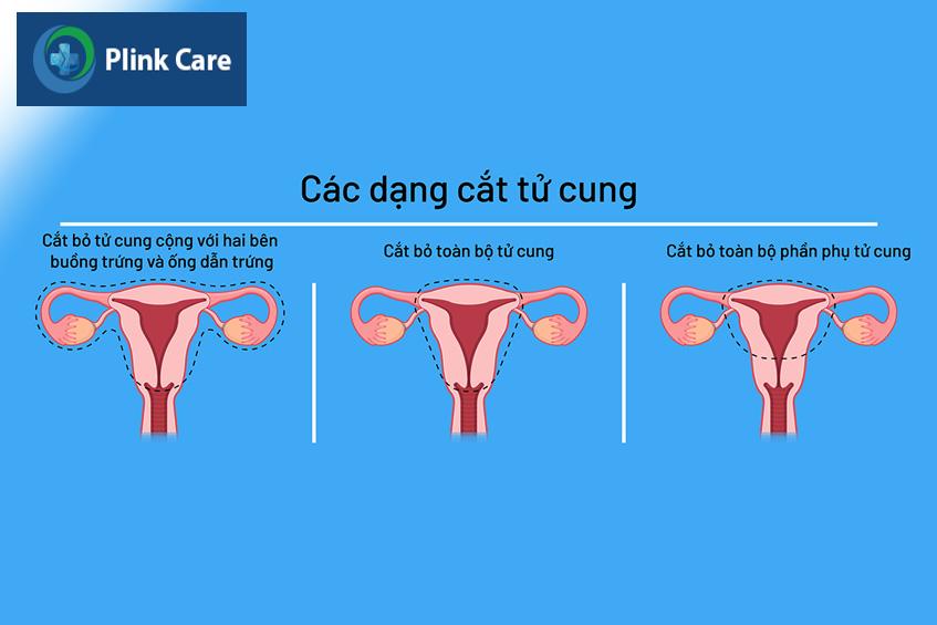 các dạng cắt bỏ tử cung