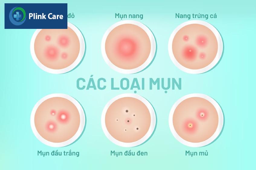Các loại mụn trứng cá tuổi dậy thì thường gặp