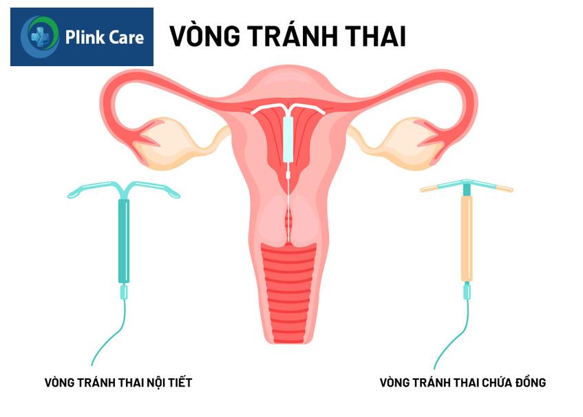 các loại vòng tránh thai