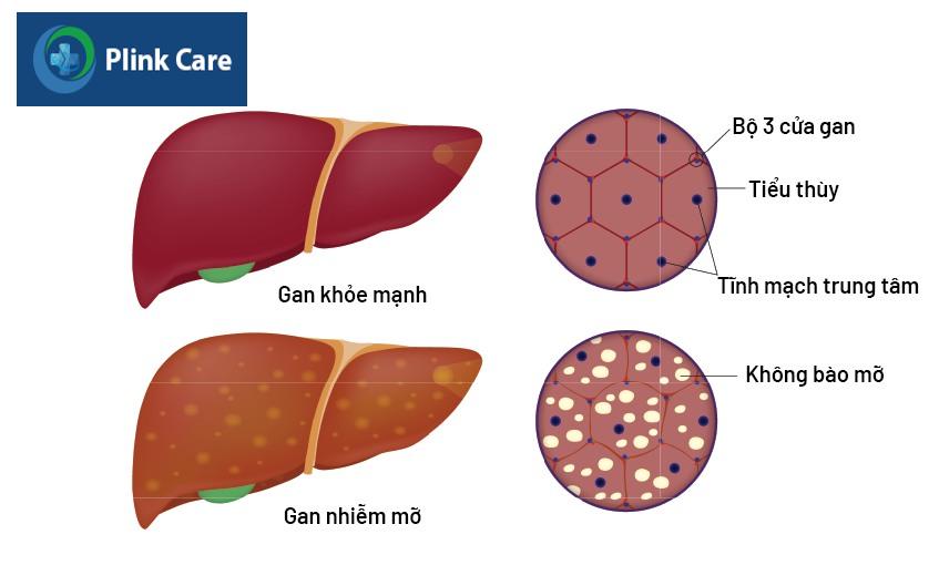 cách trị gan nhiễm mỡ