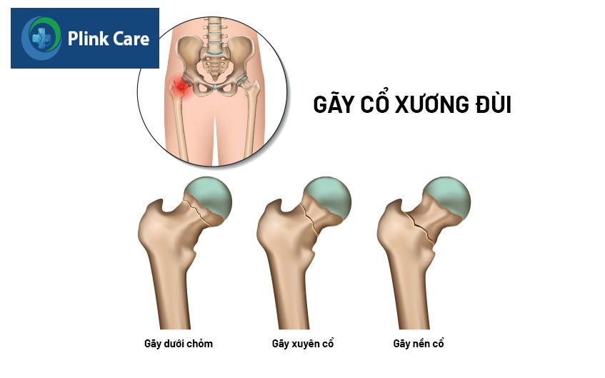 cổ xương đùi bị gãy