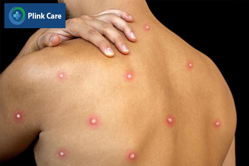 đậu mùa khỉ có chữa được không