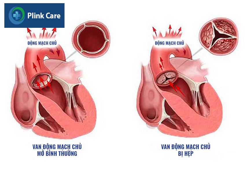 hẹp động mạch chủ