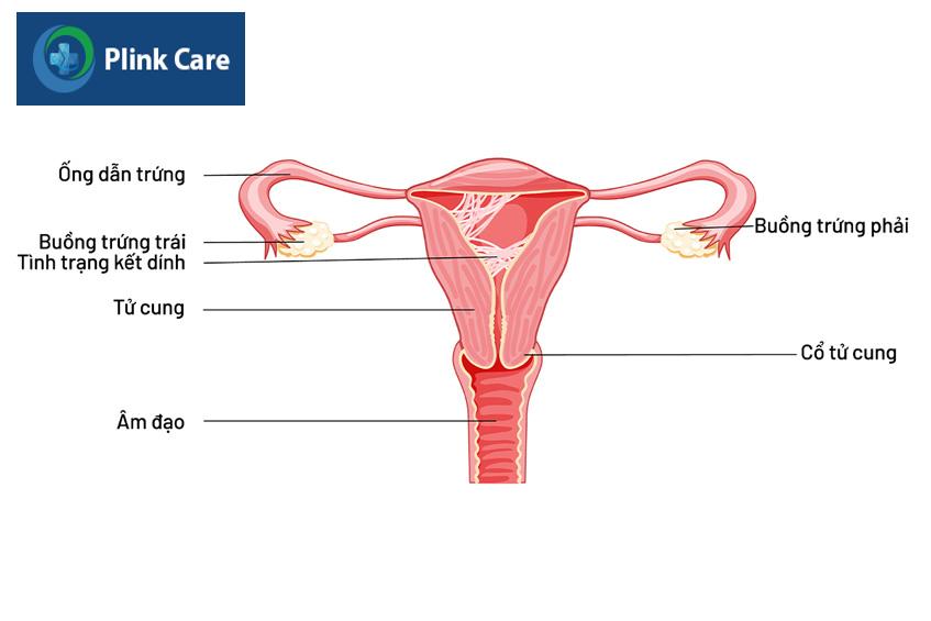 hiện tượng buồng tử cung bị dính