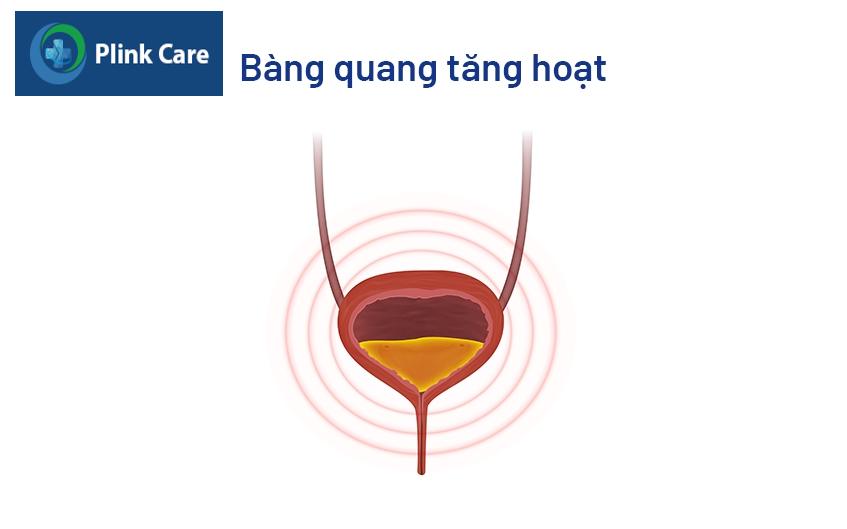 bàng quang tăng hoạt