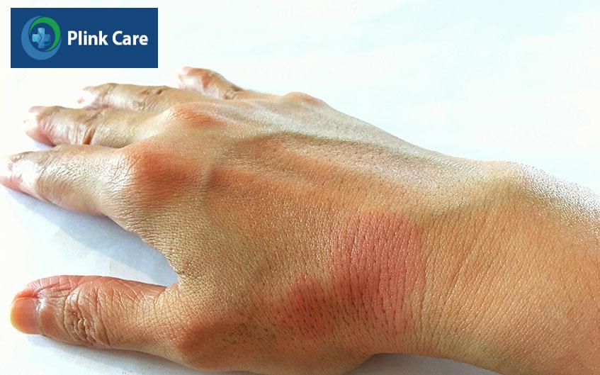 lupus ban đỏ là gì