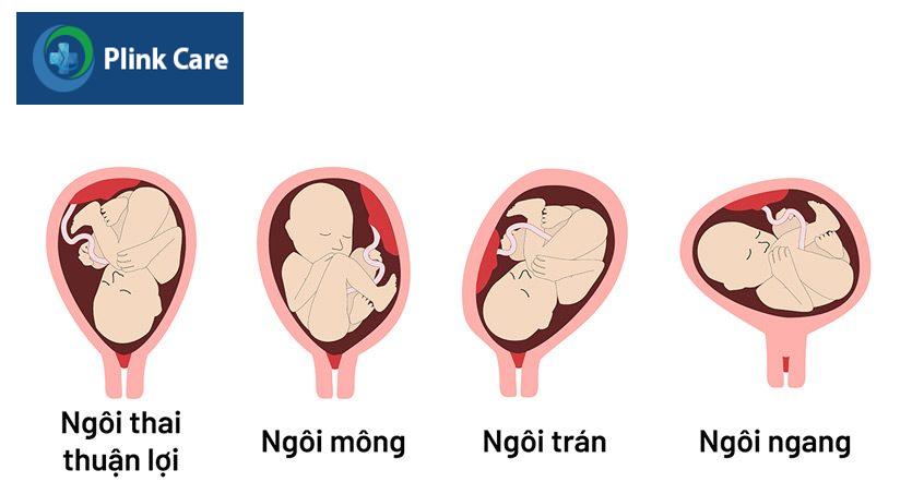 ngôi thai không thuận lợi