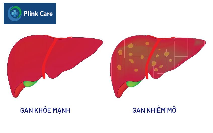 nguyên nhân gan nhiễm mỡ độ 1