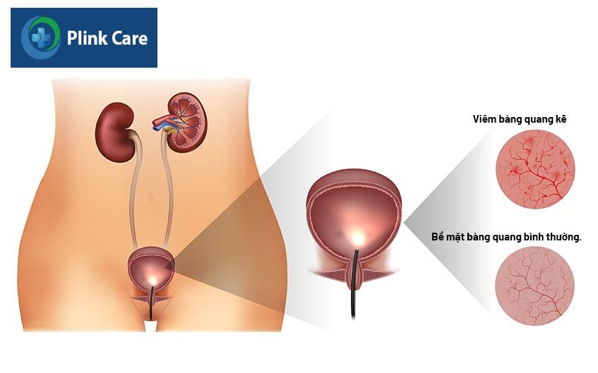 nguyên nhân tiểu không kiểm soát ở nữ