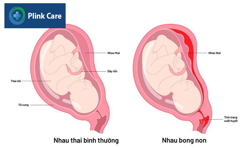 nhau bong non là gì