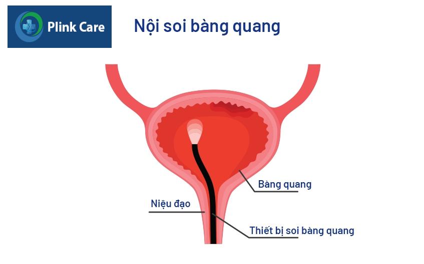 nội soi bàng quang