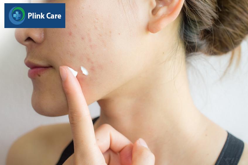 phương pháp điều trị mụn trứng cá