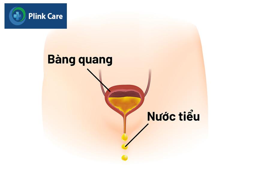 són tiểu sau sinh