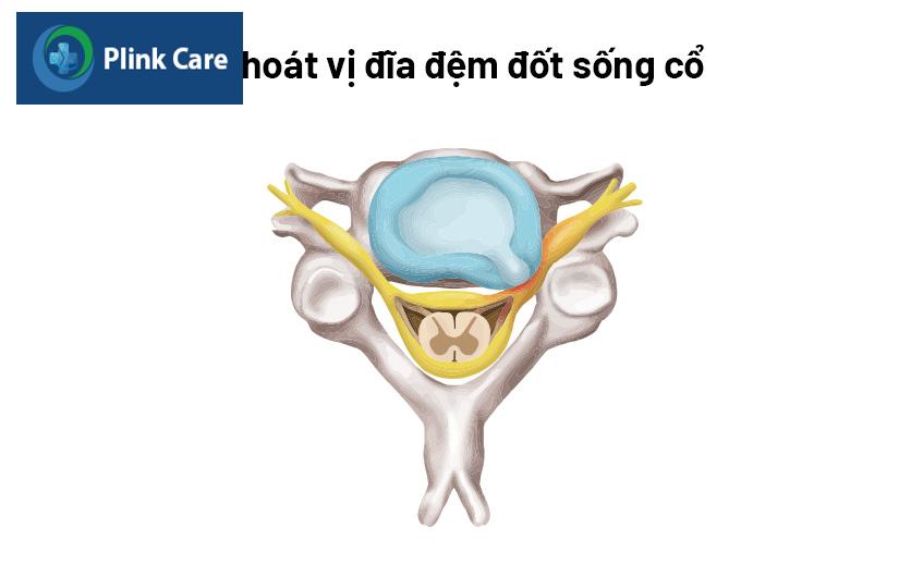 thoát vị đĩa đệm cổ