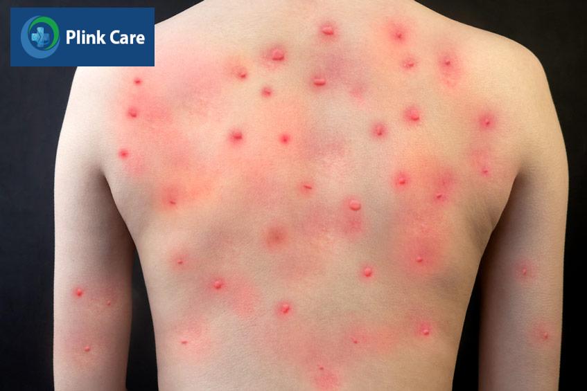 thuốc kháng virus brincidofovir
