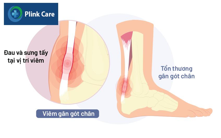 tổn thương gân bàn chân thường gặp