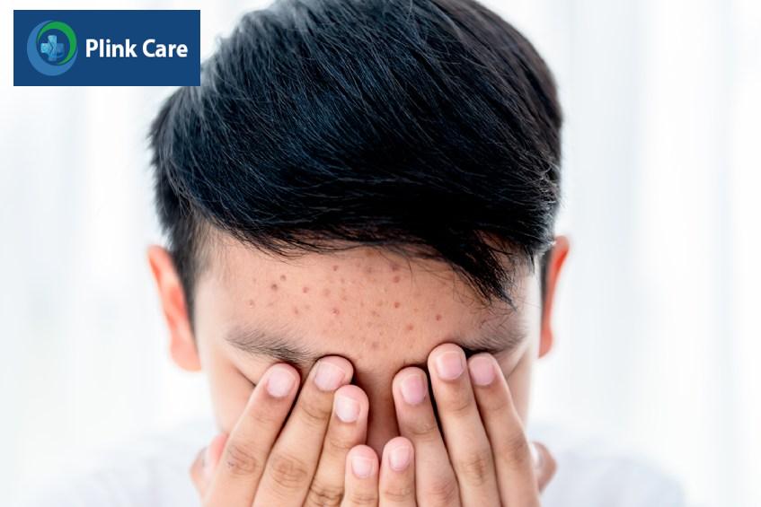 tổng quan mụn trứng cá