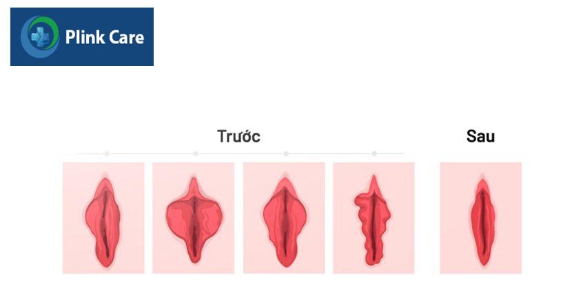 trước và sau khi thu hẹp cô bé