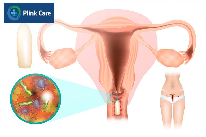 vi khuẩn, nấm candida