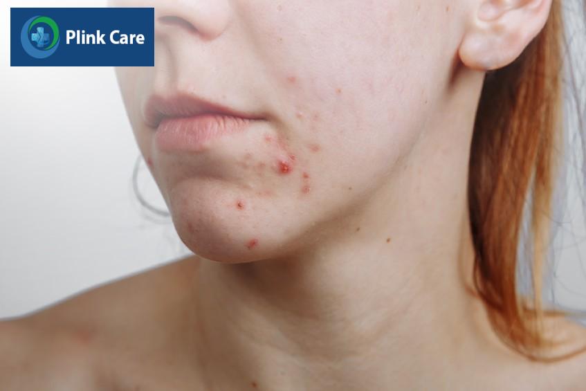 vì sao xuất hiện mụn trứng cá tuổi teen