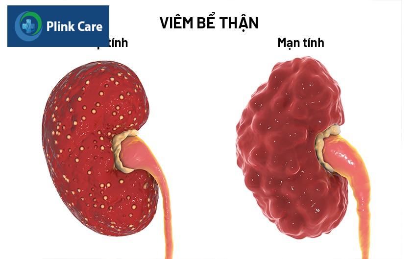 viêm bể thận là gì