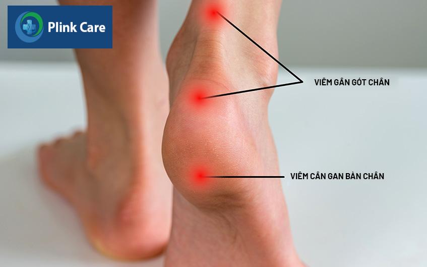viêm cân gan ở bàn chân
