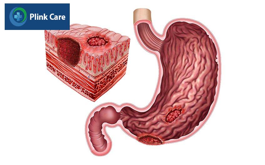 viêm dạ dày cấp là gì