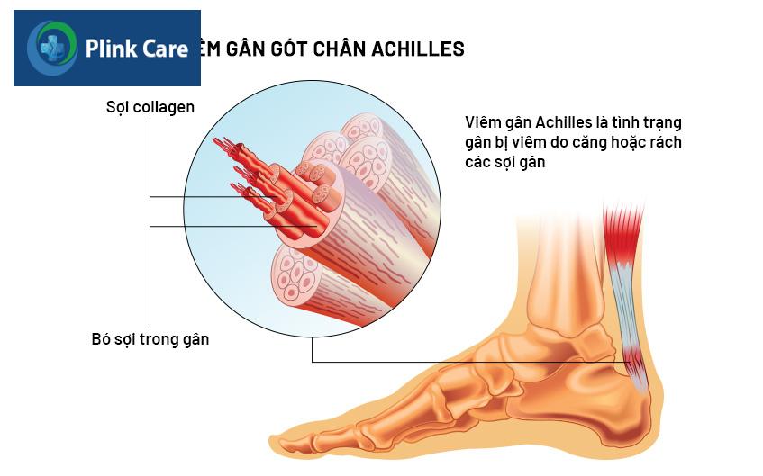 viêm gân achilles là gì