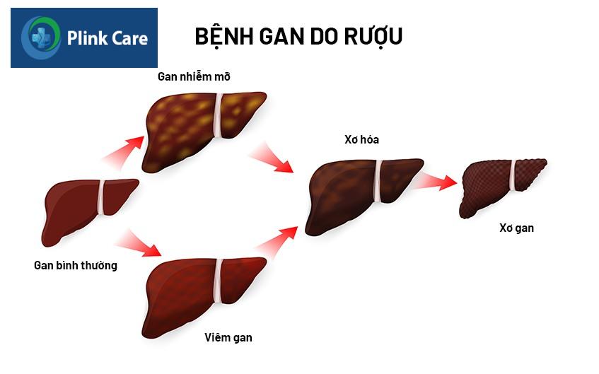 xơ gan rượu