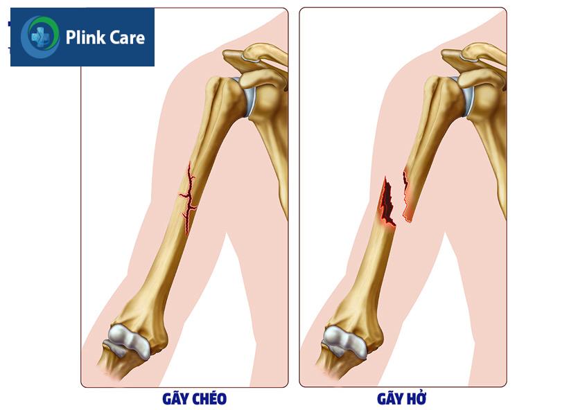xương cẳng tay bị gãy