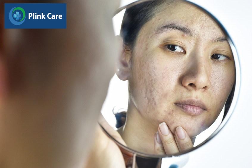 yếu tố nguy cơ phát triển mụn trứng cá