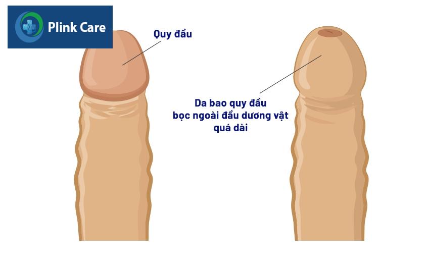 bao quy đầu dài là gì