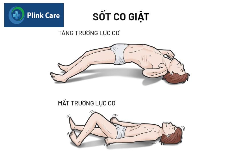 bệnh nhân tăng trương lực cơ và mất trương lực cơ