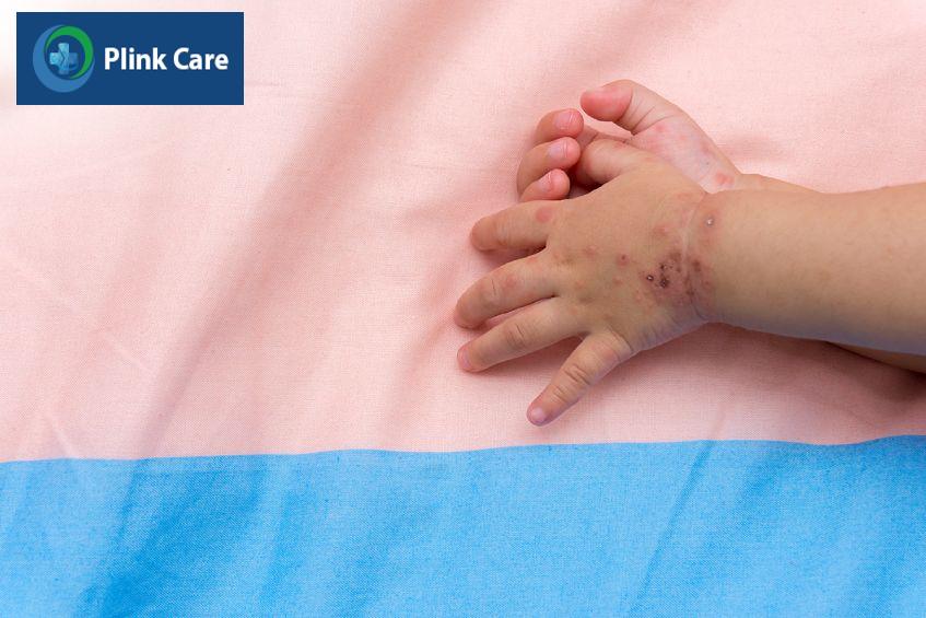 bệnh tay chân miệng có khả năng lây lan nhanh