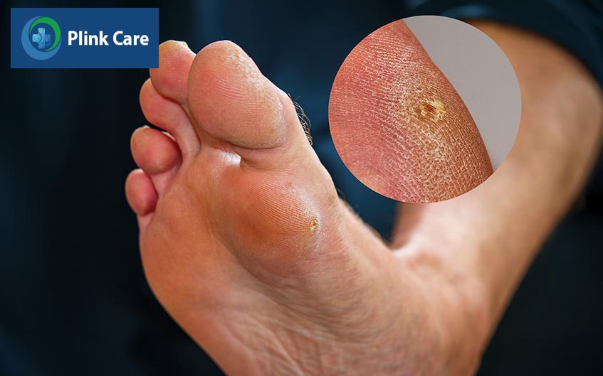 biến chứng bàn chân tiểu đường