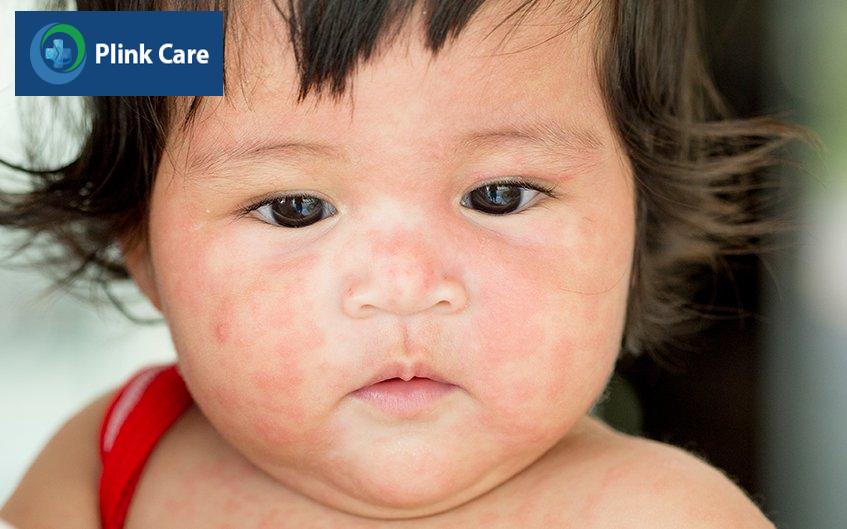 biến chứng sốt phát ban ở trẻ nhỏ