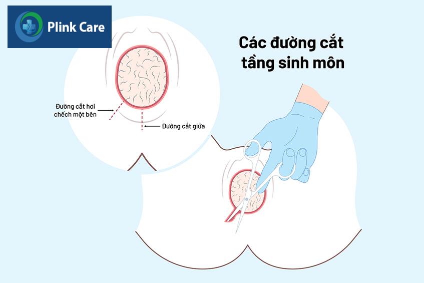 các đường cắt tầng sinh môn