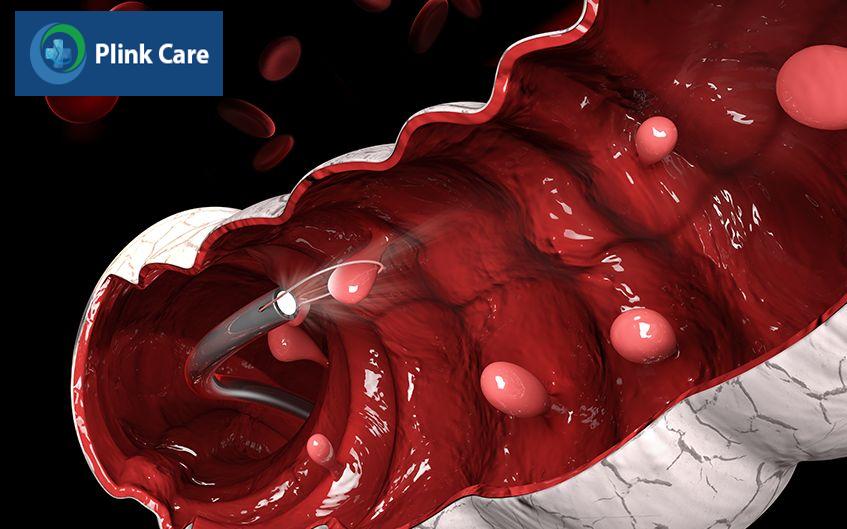 các loại polyp dạ dày