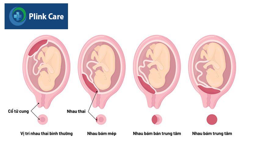 các vị trí rau tiền đạo