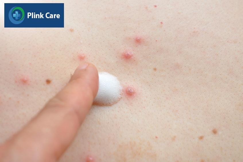 cách điều trị mụn trứng cá ở lưng