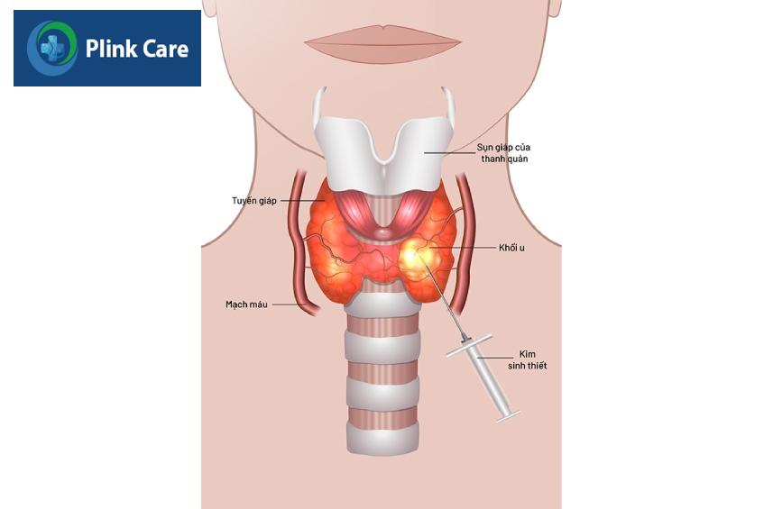 chọc sinh thiết tuyến giáp